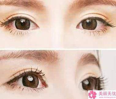 广东韩妃李宗磊祛眼袋效果好是如何做到的？案例了解+坐诊地址+预约通道