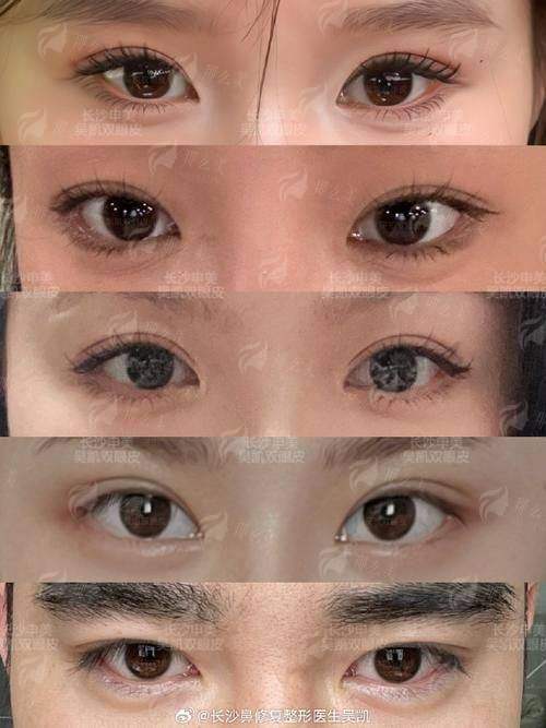 三、广东韩妃整形外科医院祛眼袋术后护理要点