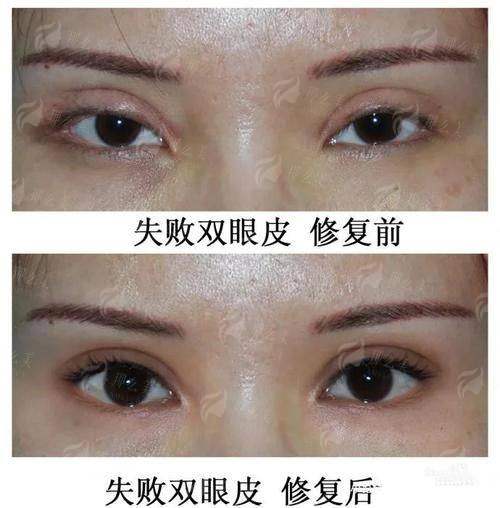 重庆星荣谭加医生眼修复靠谱吗？真实患者分享恢复过程，避坑必看！