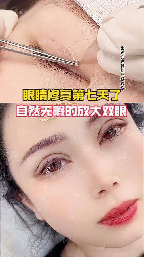 二、重庆星荣谭加医生眼修复真实实例分享