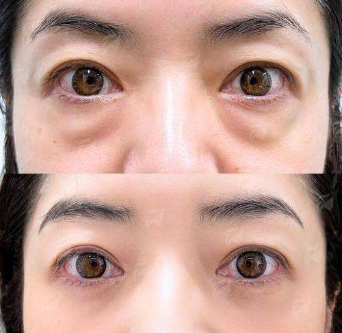 广东祛眼袋哪家强？稚美五维微痕技术对比传统方法，效果差距太明显！