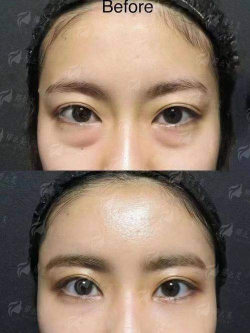 二、稚美五维微痕祛眼袋技术对比传统方法，成效差距太明显！