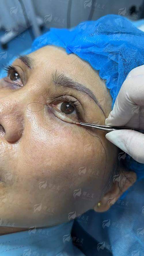 南京祛眼袋医院推荐：华美/艺星/美贝尔/华韩/省医院整形科医生技术全解析