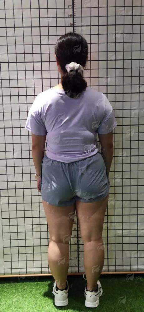 二、淮安唯尔美腰腹吸脂价格贵不贵？