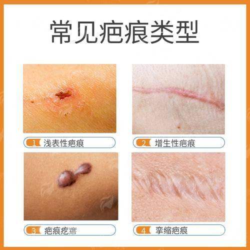 上海瑞椿疤痕科胥肖琴医生做的好吗？价格分析+特色技术全揭秘