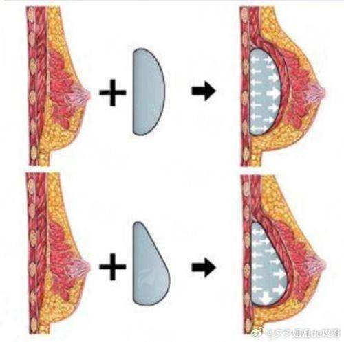武汉艺星李盛春隆胸价格参考来啦！了解医生特色技术，点击预约不迷路！