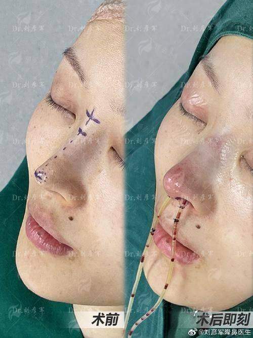 重庆星荣朱晓浩鼻修复口碑如何？真实案例+价格对比，预约方式全公开！