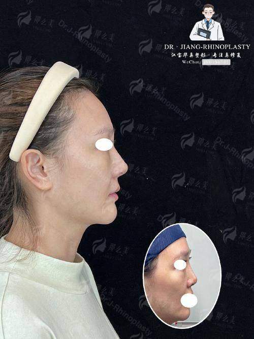 二、重庆星荣朱晓浩鼻修复真人实例成效揭秘