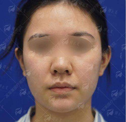 四、成都做面部提升，为什么推荐纯曦林靖？