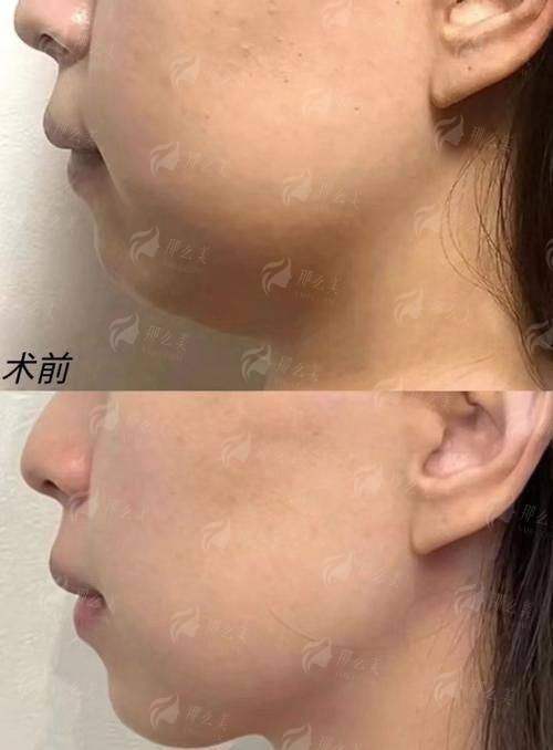 二、成都纯曦的面部提升真实反馈如何？