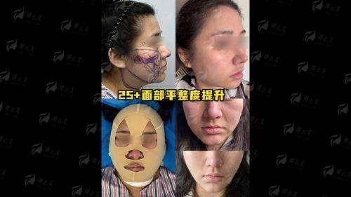 成都纯曦林靖做面部提升靠谱吗？医生技术+真实反馈，看完再决定！