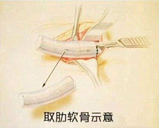 二、广州海峡黛梦妥假体隆胸术后修复全记录