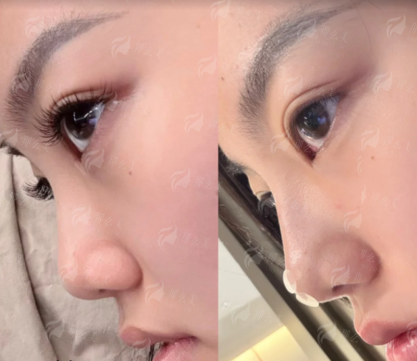 四、筋膜修复常见问题解答