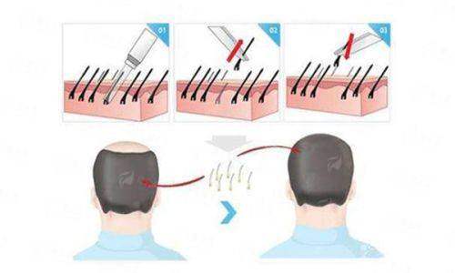 三、淮安艺后医疗整形医院植发价格贵吗？