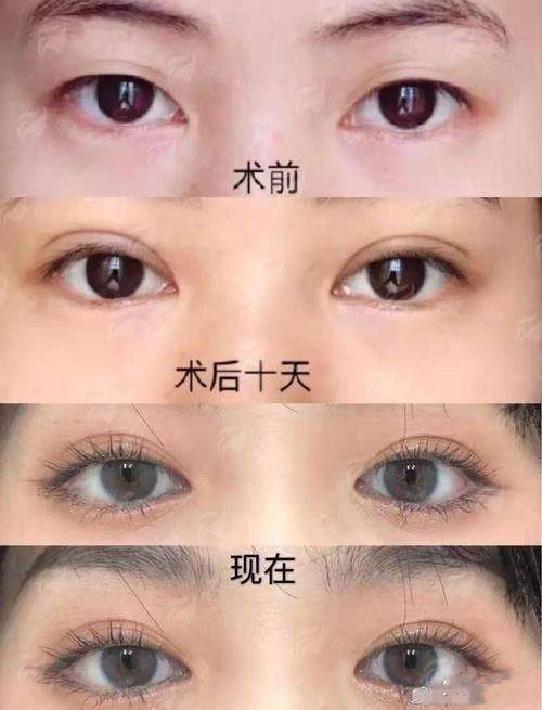 三、云南悦之美杨佳健医生真人实例成效对比