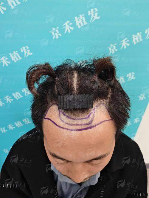 二、陈男男医生的植发技术特色是什么？