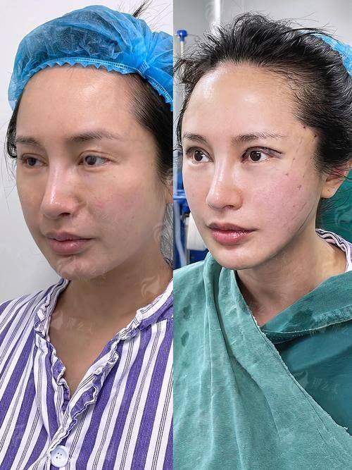 哈尔滨爱琪医美筋膜折叠提升16800起靠谱吗？医生技术+术后护理全解析