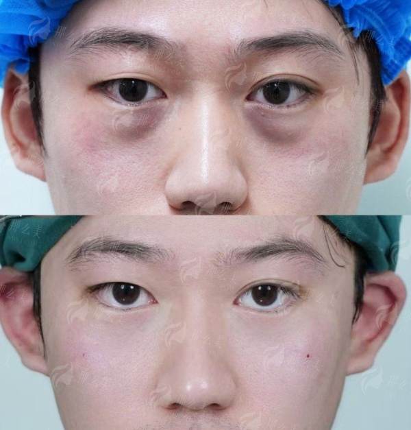 四、惠州稚美医疗祛眼袋如何预约？