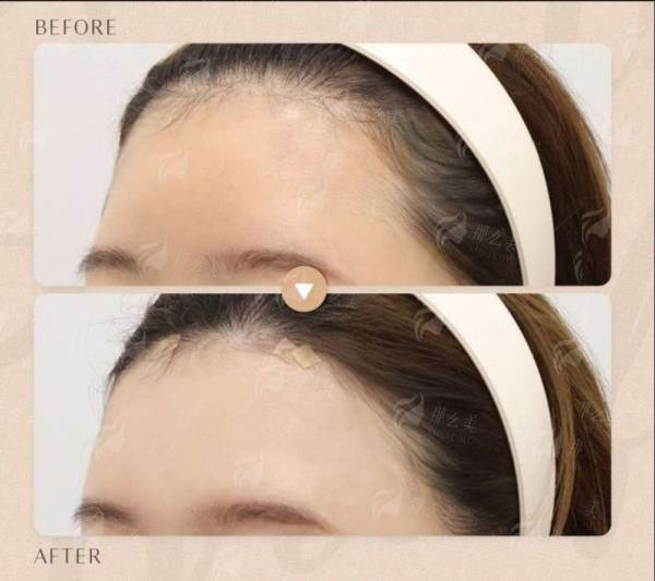 二、台州温岭韩辰眉下提升术后成效能维持多久？