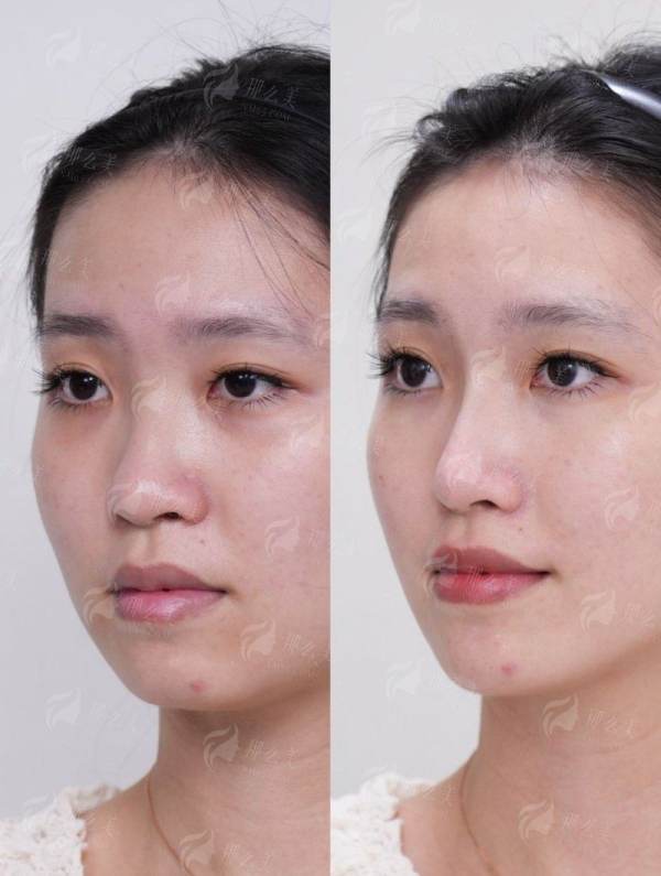 台州温岭韩辰眉下提升靠谱吗？到院地址+术后效果全公开，速看！