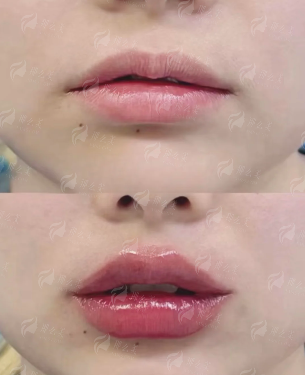 西宁青美余红敏微笑唇vs传统丰唇术：区别在哪？附医生特色技术介绍