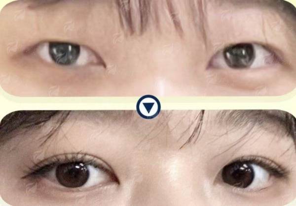 二、曹珂双眼皮手术的三大技术优势