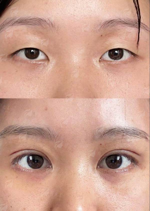 广东韩妃曹珂双眼皮真实评价如何？案例全解析，附及24小时预约通道！