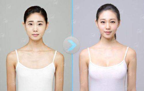 三、深圳阳光罗志敏隆胸价格贵不贵？