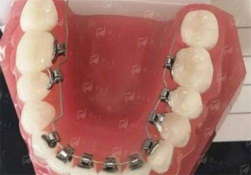 江西南昌贝尔口腔牙齿矫正价格全公开！隐形矫正VS金属托槽对比看