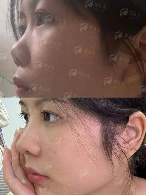 二、重庆当代王旭明vs谢锦清隆鼻医生适合人群分析