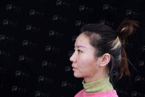 【深度对比】重庆当代王旭明vs谢锦清隆鼻医生谁更强？真实案例全解析