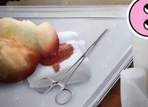 珠海贞美医疗隆胸全解析：假体VS自体脂肪，哪种更适合你？