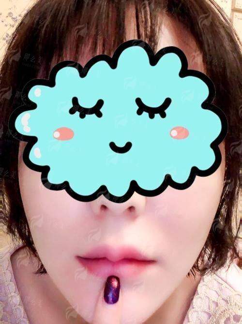 西宁青美余红敏微笑唇案例全公开！真人效果对比看，预约方式速get