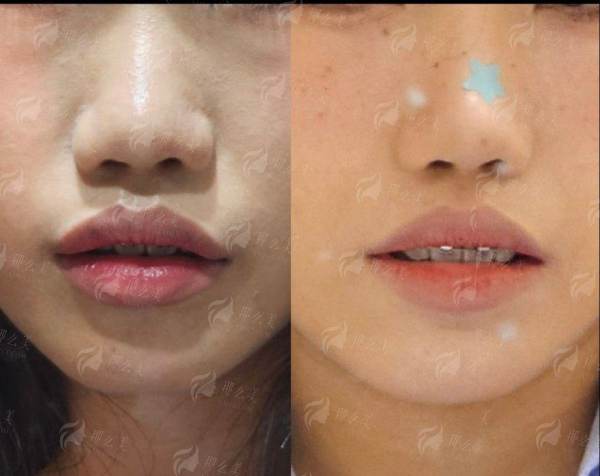  武汉紫荆医院项昌峰颌面整形怎么样？真实案例全公开，效果对比看！