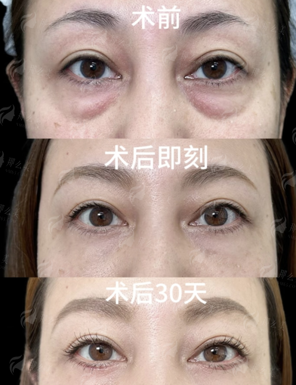 四、惠州稚美祛眼袋术后护理贴心，服务有保护