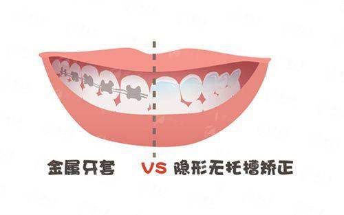 三、兰州润玉口腔隐形矫正流程是怎样的？