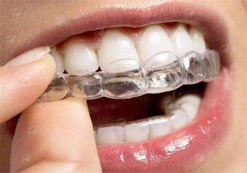 兰州润玉口腔隐形矫正多少钱？2026最新价格表+优惠活动抢先看！