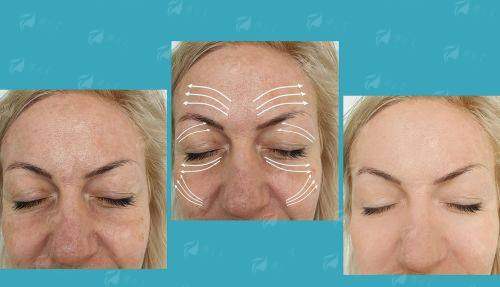 三、深圳颂美乔雅登丰颜价格刺客？同城医院对比表