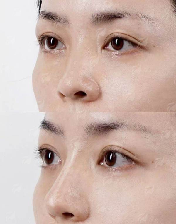 二、芜湖名姝医疗美容隆鼻价格贵不贵?2026全新收费分析