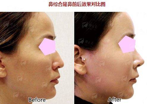 上海美联臣李湘原轮廓技术怎么样？医生特色+术后效果全公开，速看！