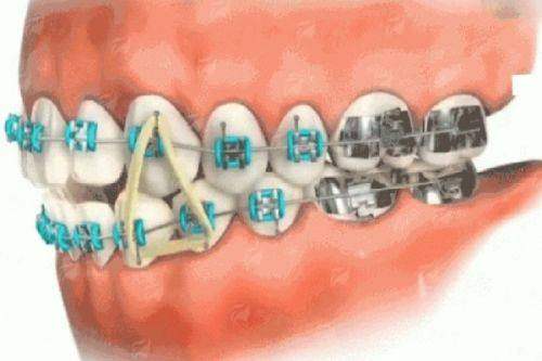 三、江西抚州佰诺口腔隐形矫正预约方式有哪些？