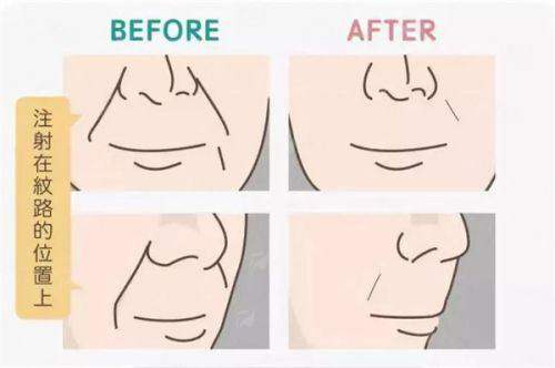 想了解杭州清锴李保锴肋骨隆鼻案例效果？全解析来啦，附24小时预约通道！