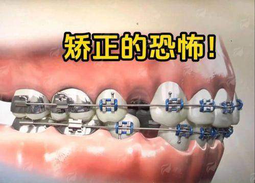 四、江西抚州佰诺口腔隐形矫正值得选择吗？