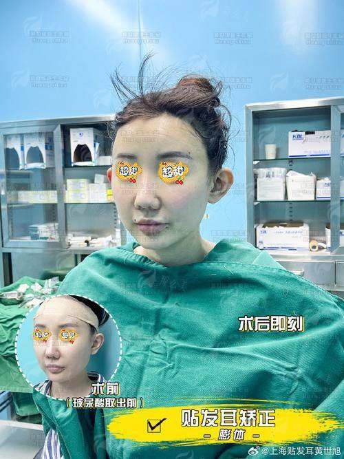 一、泰州星尚医疗美容的精灵耳技术有什么特色?