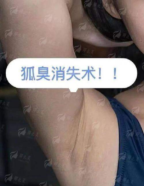 一、西安新城仁爱皮肤医院的腋臭治疗靠谱吗？