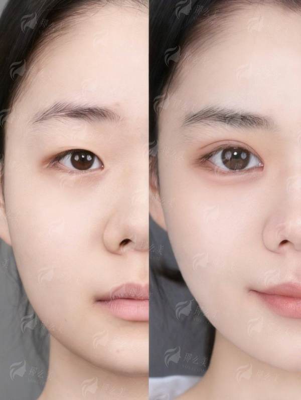 武汉五洲黄媛媛和严飞双眼皮谁最自然？别纠结，对比看效果，附医院地址与预约指南！