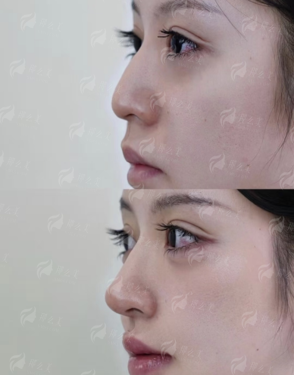 二、温州艺星黄乐vs李伟杰隆鼻报价多少？关键看需求