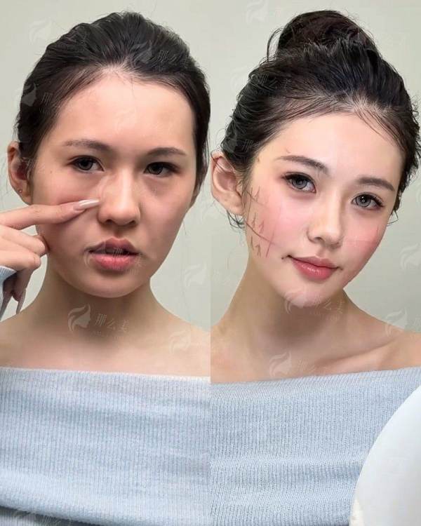 想知道杭州清锴金柱双眼皮真实评价如何？附坐诊地址及24小时预约挂号通道！