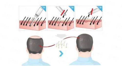 四、厦门新禾曙光植发怎么预约？术后要注意啥？