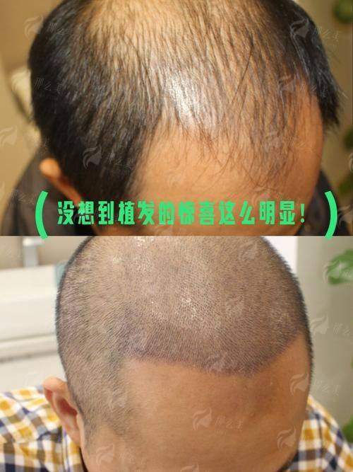 一、厦门新禾曙光植发的不剃发植发技术靠谱吗？
